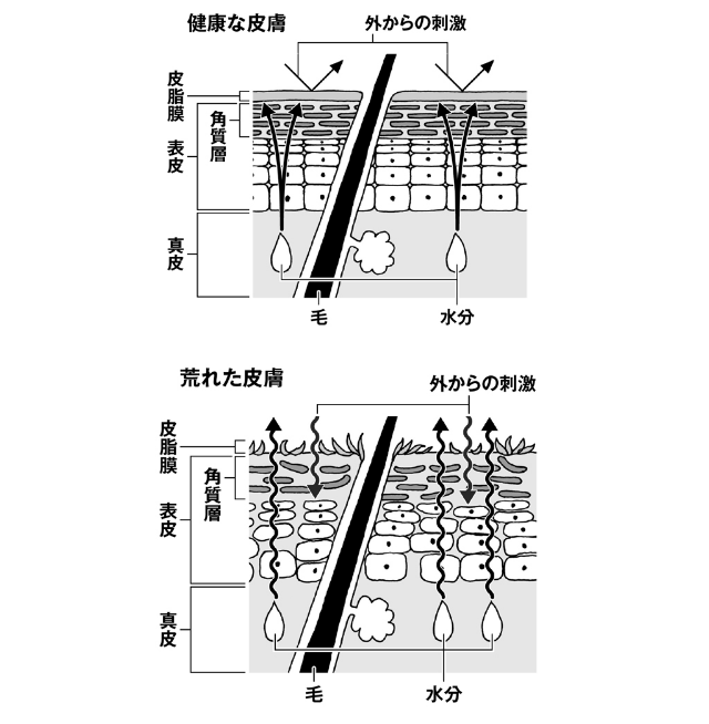 健康な皮膚と荒れた皮膚<