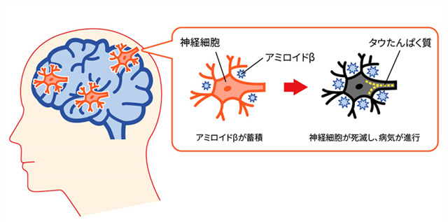 図１アミロイドβの蓄積